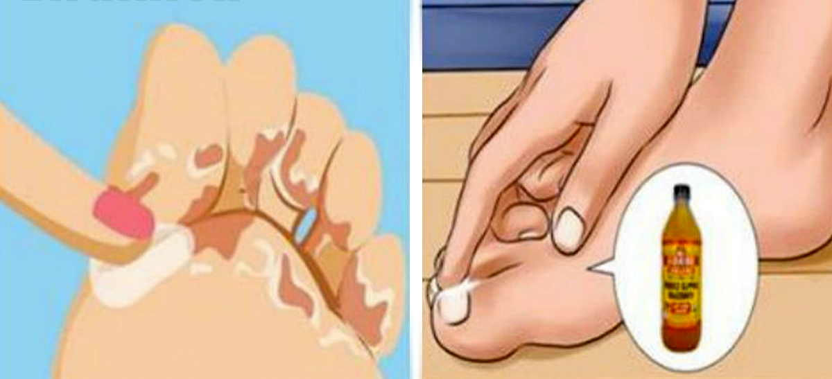 El hongo de las uñas en los pies al embarazo