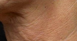 arrugas en el cuello